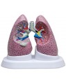 pulmão com patologia