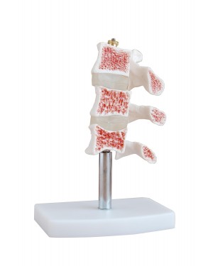 Modelo de Osteoporose COL 1134 Coleman